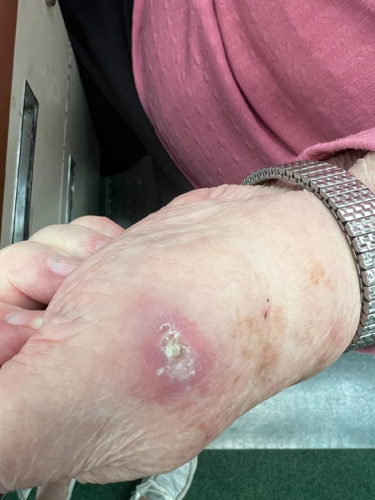 Squamous cell skin cancer on Sally's hand.